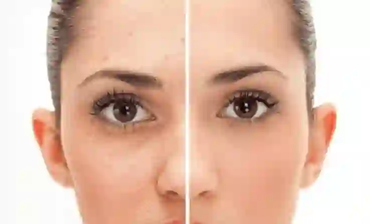 Pigmentation face pack of How to get rid of pigmentation using face packs in hindi..